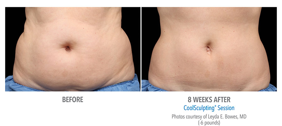 Before and After Coolsculpting results of a woman’s stomach