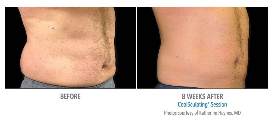 Male Abdomen before and after results of Coolsculpting