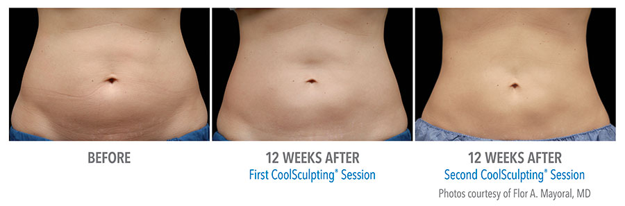 Before and after results of a woman’s flat abs after Coolsculpting treatments