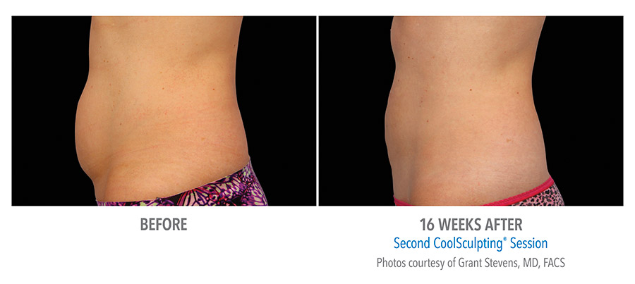 Female Abdomen after two Coolsculpting treatments