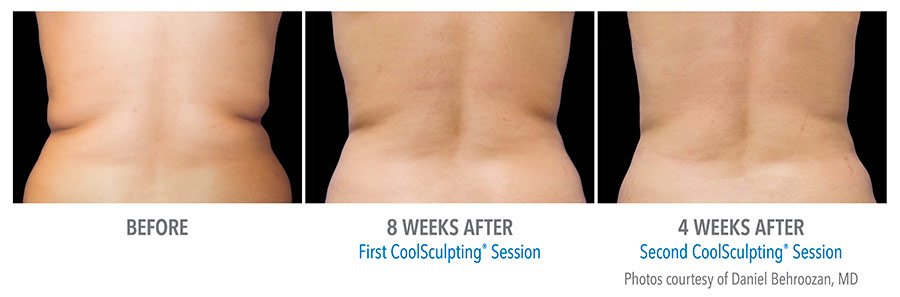 Coolsculpting results - female flank