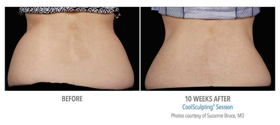 Before and After Results of the back of a woman after Coolsculpting treatment