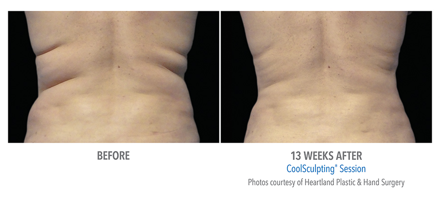 Coolsculpting results - A woman’s back before and after treatment