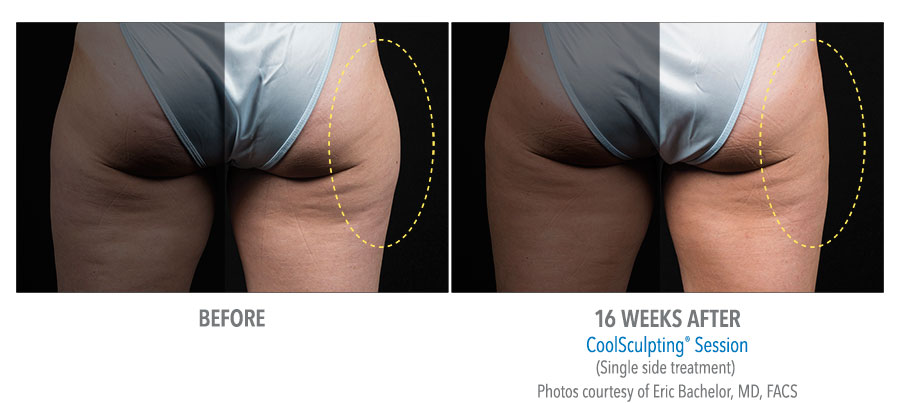 Female Buttock and Outer Thigh before and after results of Coolsculpting