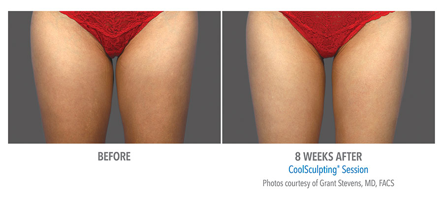 Coolsculpting Before and After results - Woman’s thighs