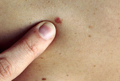 Skin Cancer Screening and Treatment