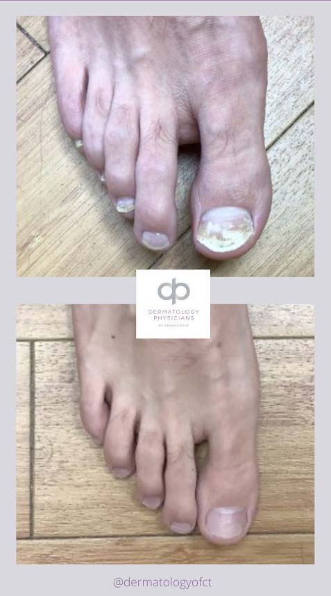 before after antifungal nail treatment