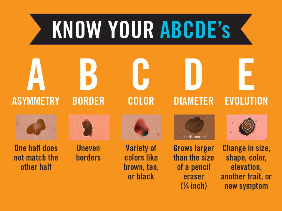 ABCs of melanoma