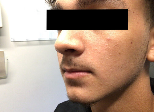 Acne Accutane After Picture