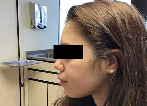 Acne Accutane After