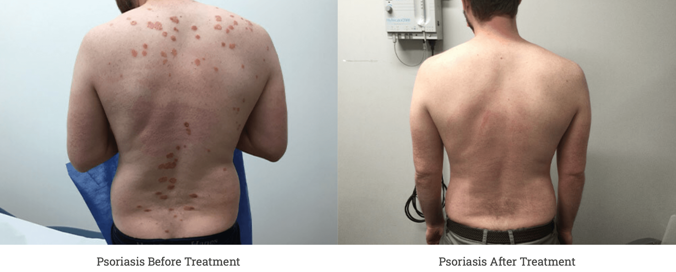 Before and After PSORIASIS treatment