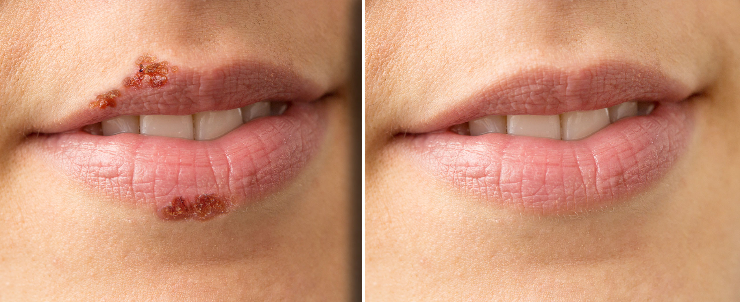 Before and After showing treatment for cold sores and herpes Dermatology of CT