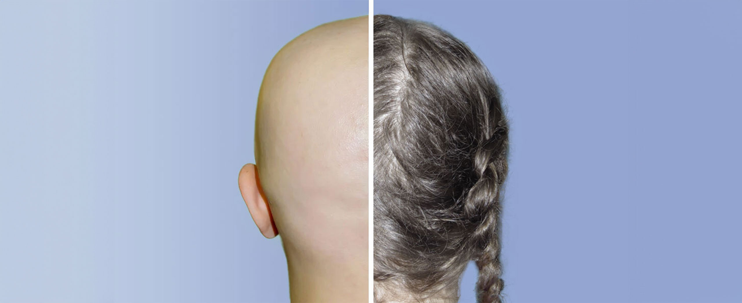 Before-and-After-showing treatment for hair loss Dermatology of CT