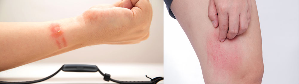 Example of Contact Dermatitis on the wrist and thigh
