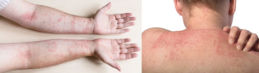 Examples of dermatitis on arms and back of neck
