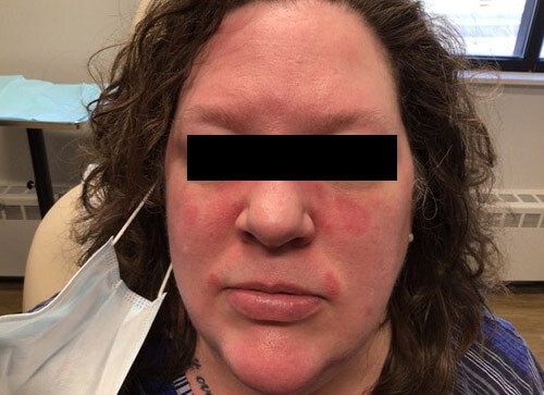 Facial Psoriasis Before Treatment