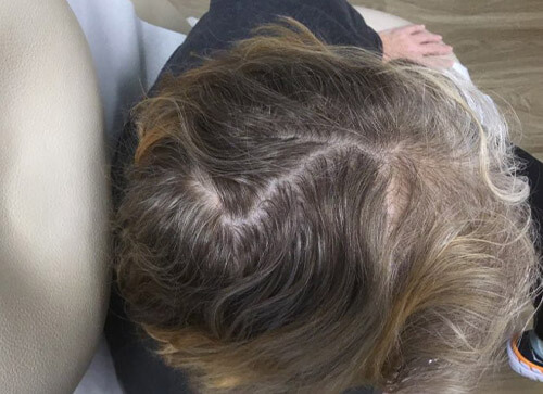 Hair Loss After Treatment