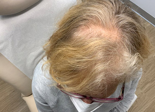 Hair Loss Before Treatment