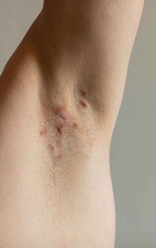 Hidradenitis Suppurativa symptoms