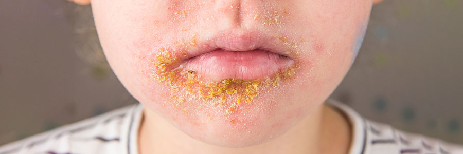 How to Recognize Impetigo