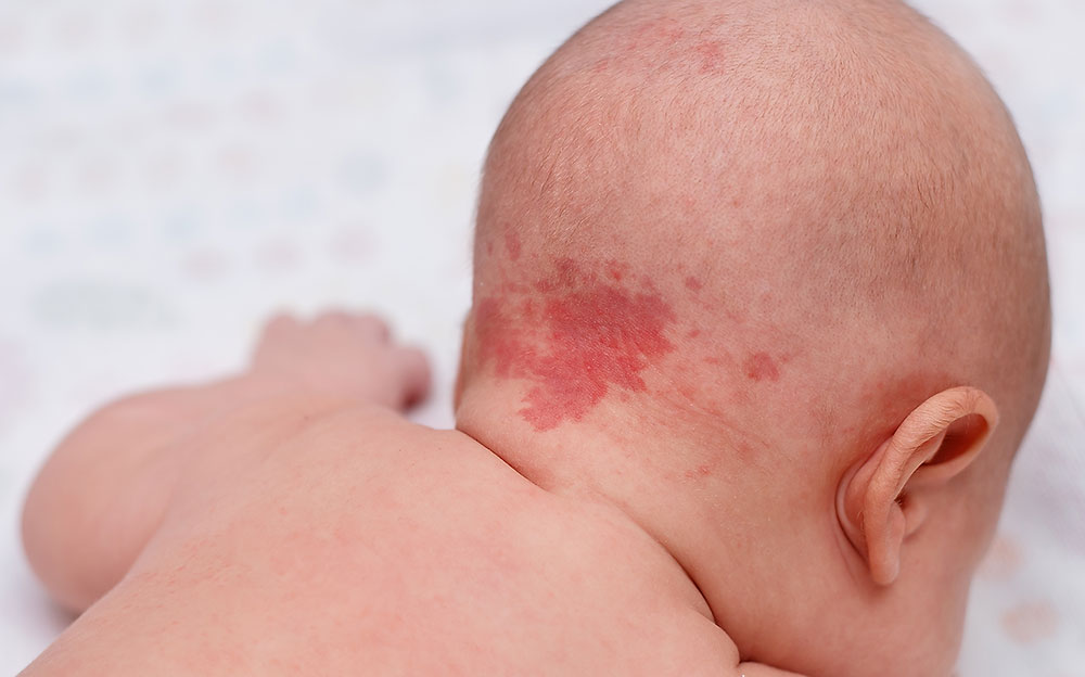 Infant hemangioma on the back of head and neck.jpg