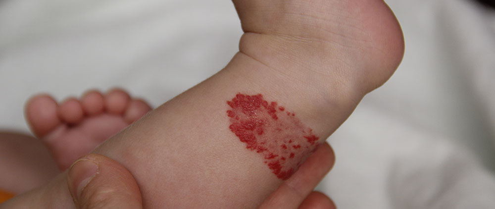 Infant hemangioma on the leg of a little boy