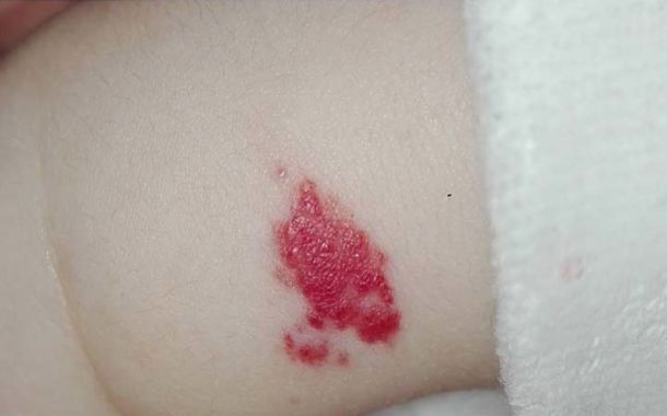 Infantile Hemangioma Dermatology Physicians Of Connecticut