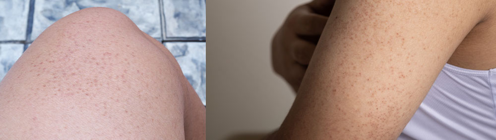 Keratosis Pilaris also know as chicken skin on leg and arm