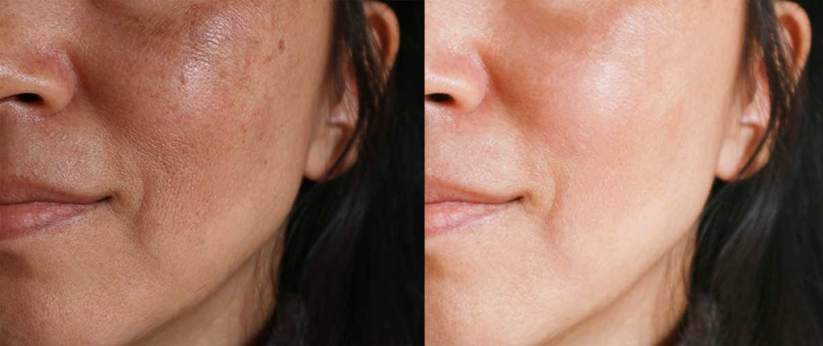 Melasma before and after treatment at derm of CT