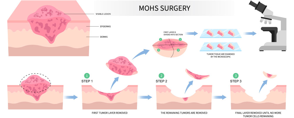Mohs surgery basal cell microscopic reconstruction