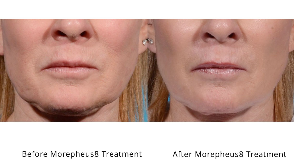 Morpheus8 before and after