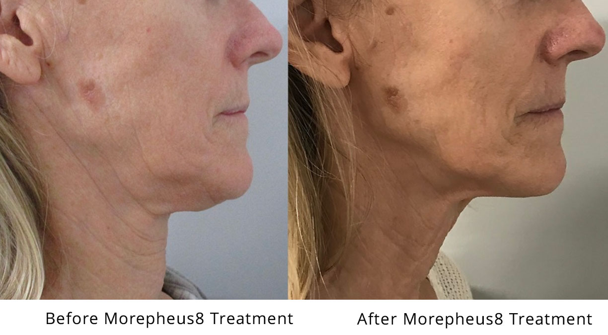 Morpheus8 before and after