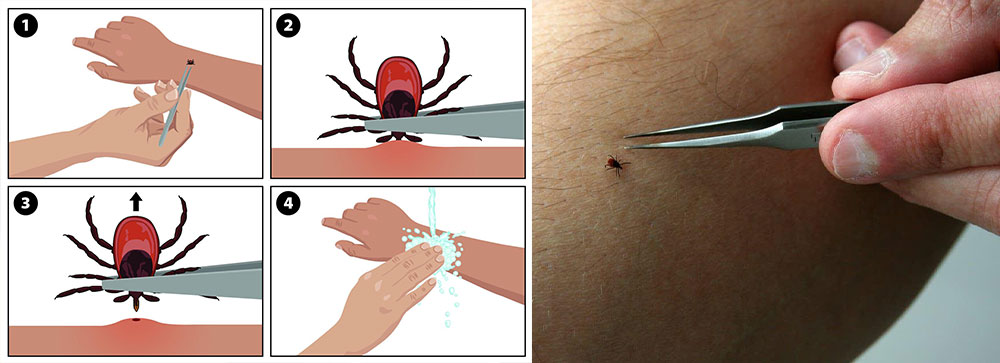 Removing an attached tick from the skin with fine-tipped tweezers