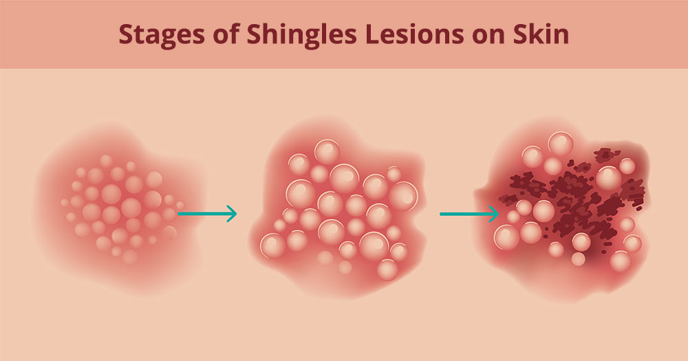 Stages of Shingles Lesions on Skin
