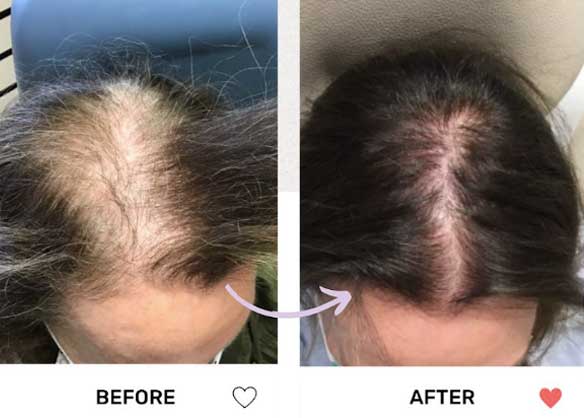 Dermatologists are using an old medication for hair loss in a new ways -  Dermatology Physicians of Connecticut