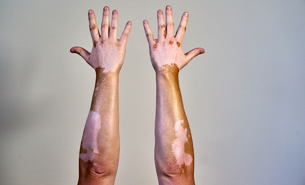 Vitiligo-showing-signs-on-left-and-right-hands Vitiligo showing signs on left and right hands