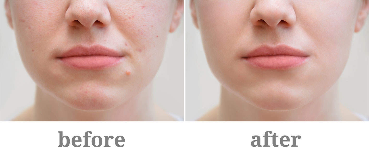 acne before and after treatment