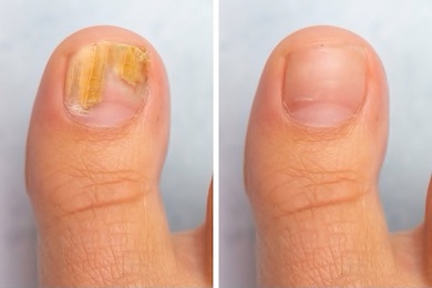 Guide to Fungus Free Healthy Nails