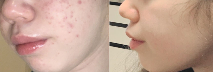 before and after ance treatment in CT