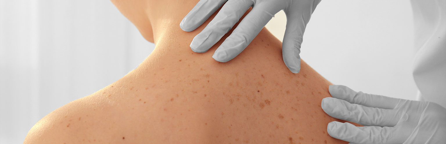 Checking skin for Non-Melanoma Skin Cancer