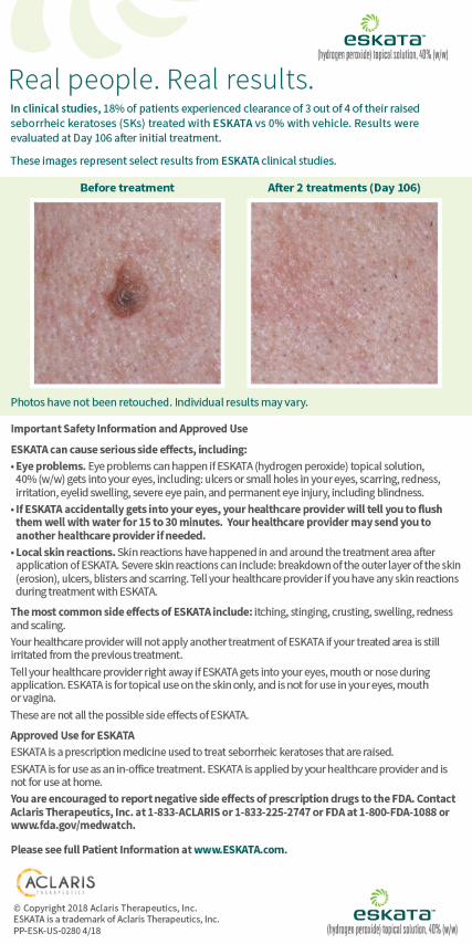 Eskata hydrogen peroxide chart before and after