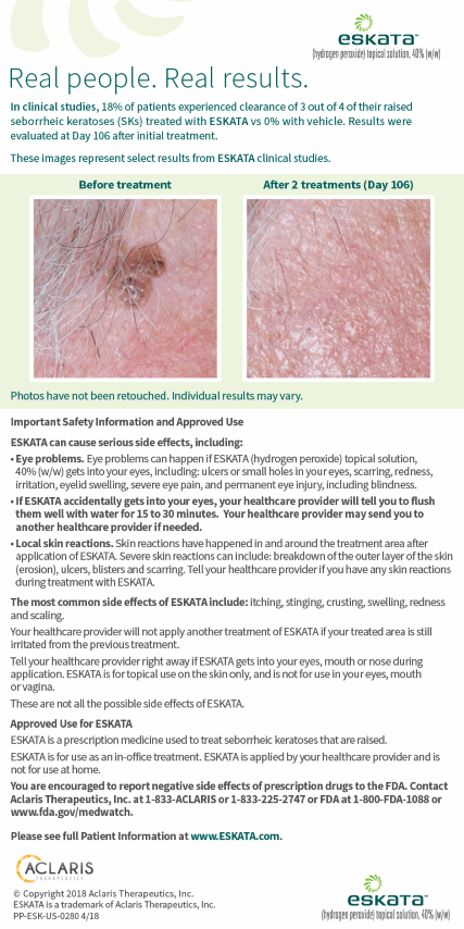 Eskata hydrogen peroxide topical solution chart before and after