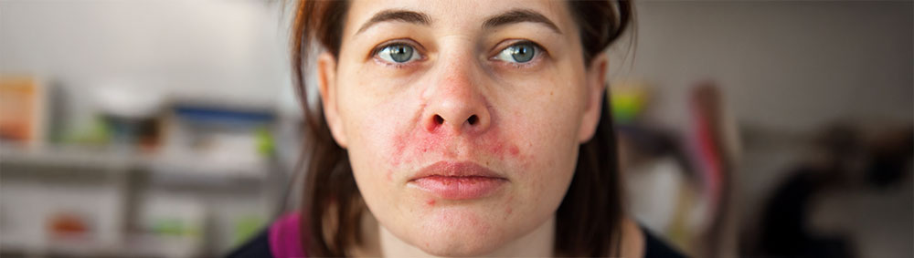 Example of Perioral Dermatitis on a woman's face