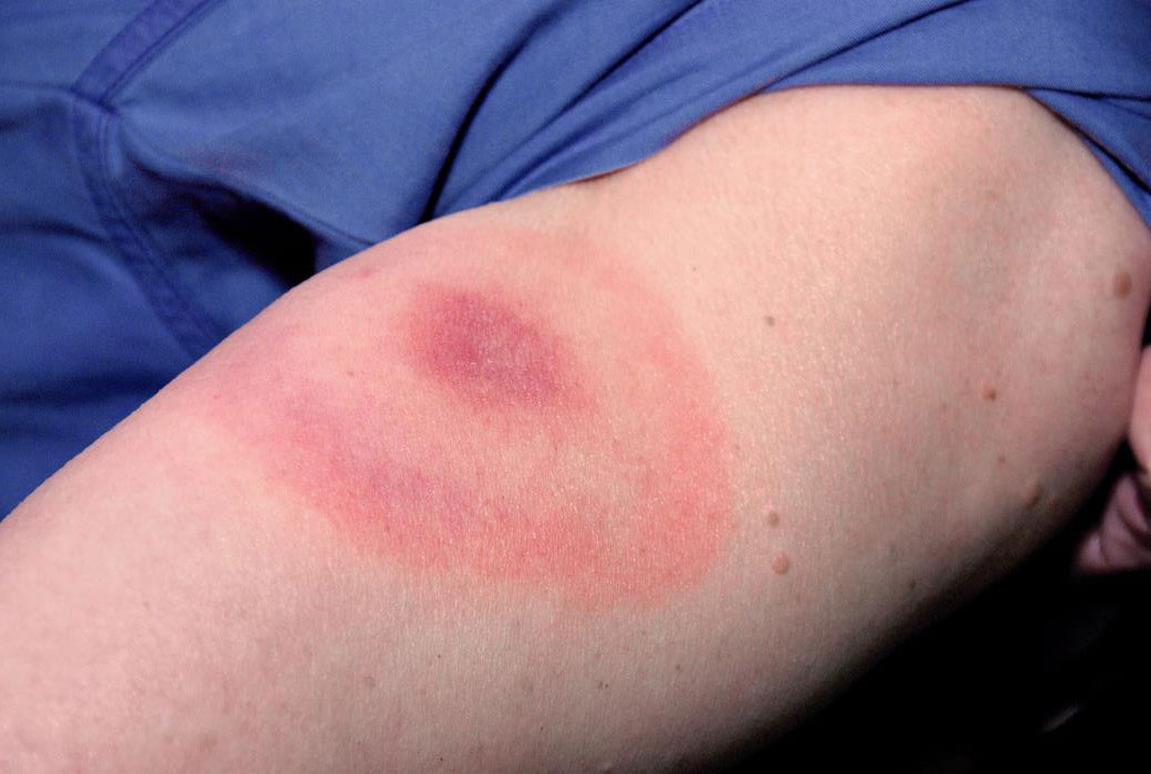 example of lyme disease tick bit bullseye