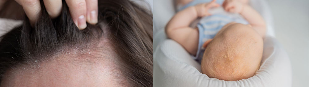 example of seborrheic dermatitis on an adult and a child