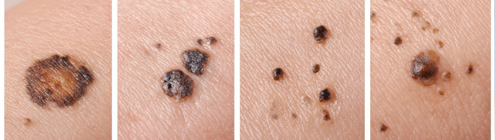 examples of Melanoma
