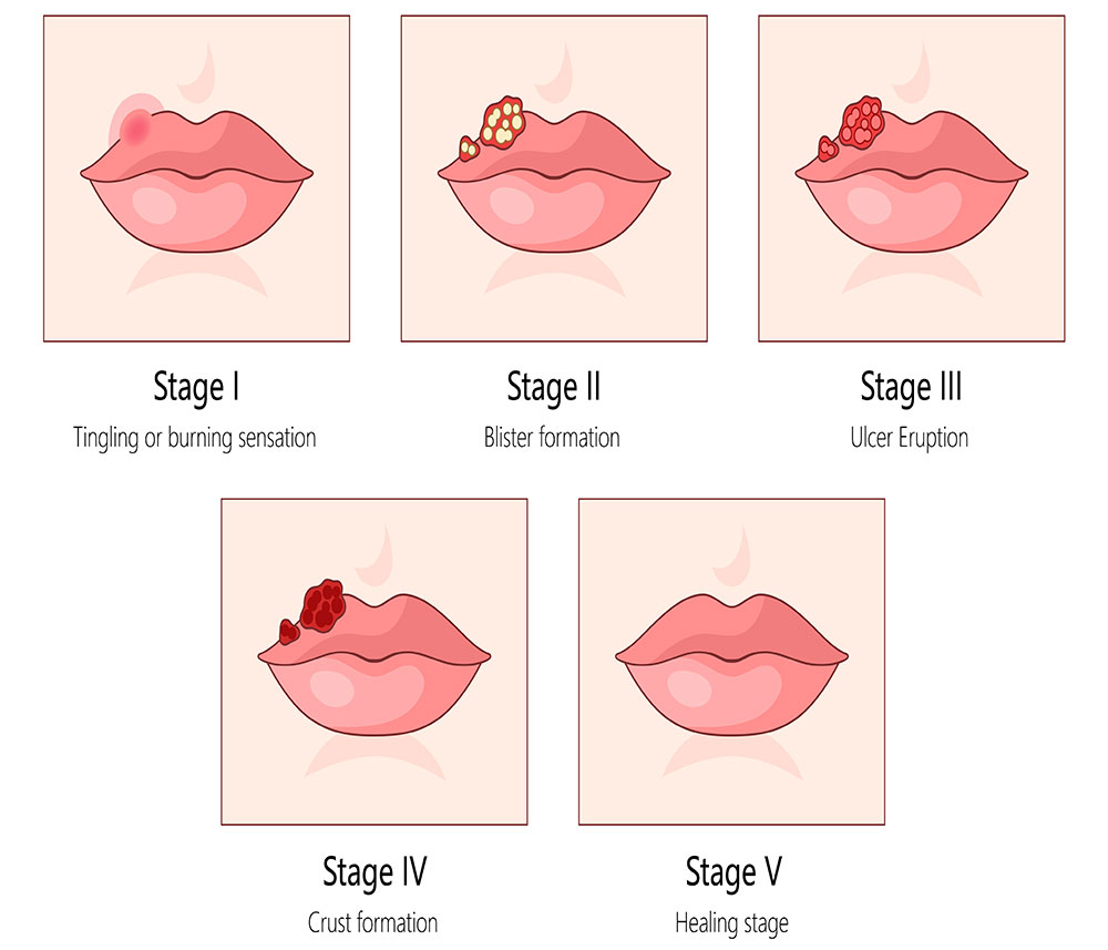 graphic showing the stages of a cold sore