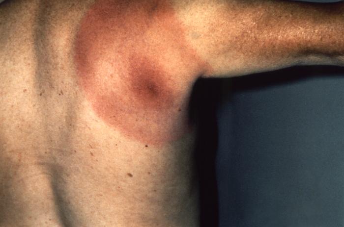lyme disease tick bite