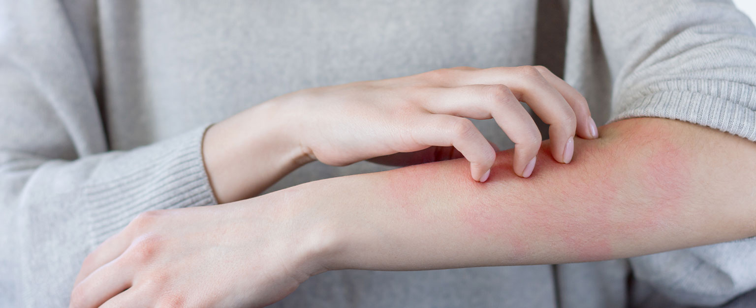 managing skin allergies