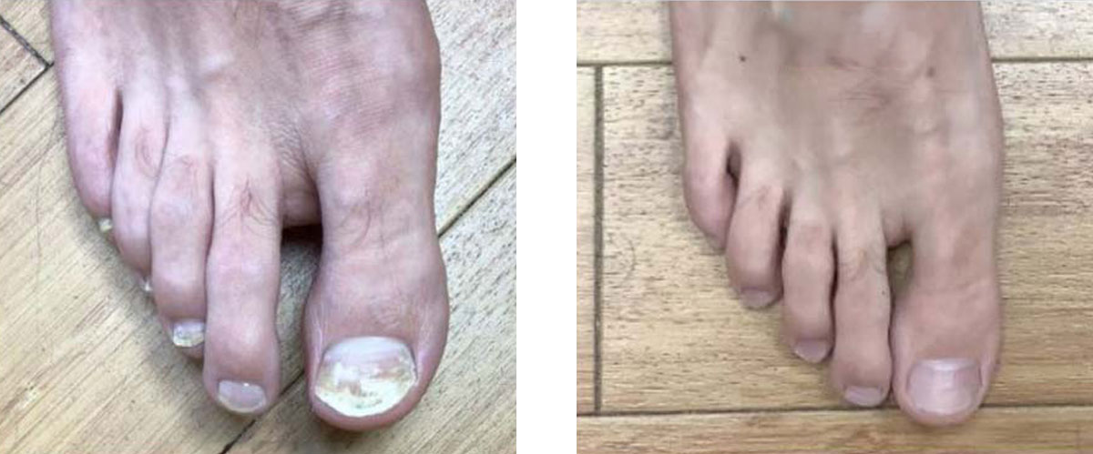 nail fungus before and after treatment